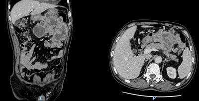Epithelioid inflammatory myofibroblastic sarcoma: a case report and brief literature review